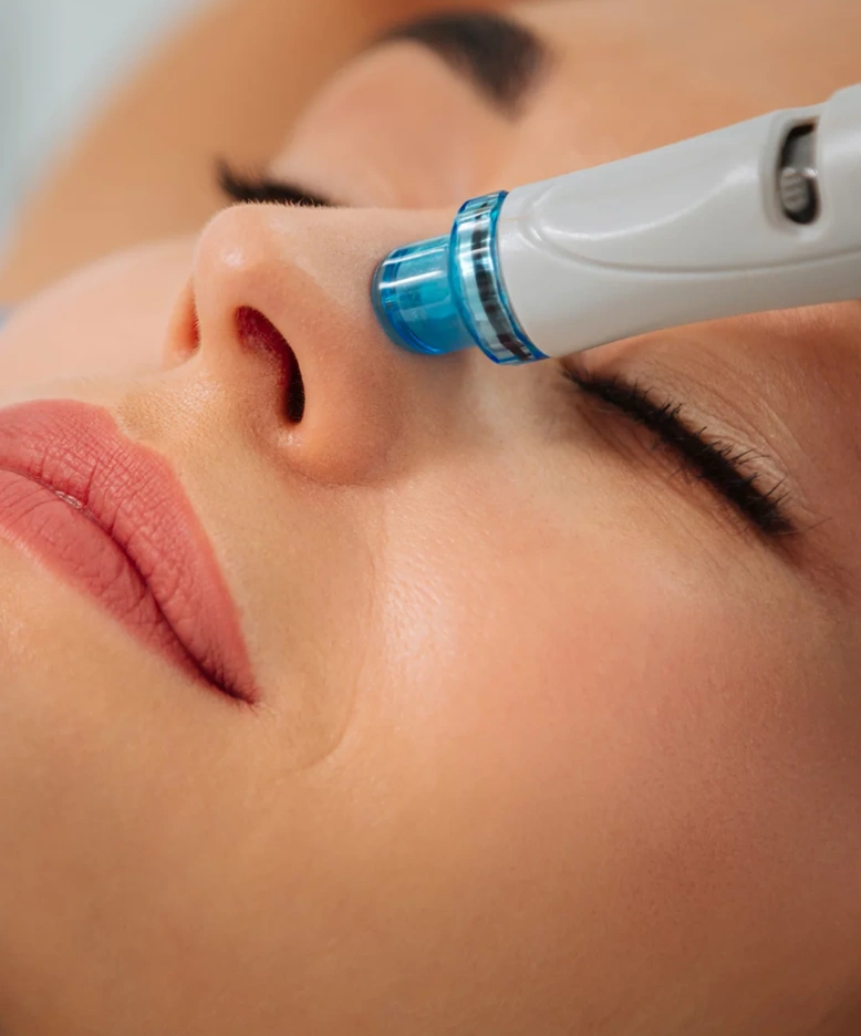 Beneficios del tratamiento Hydrafacial en Marbella