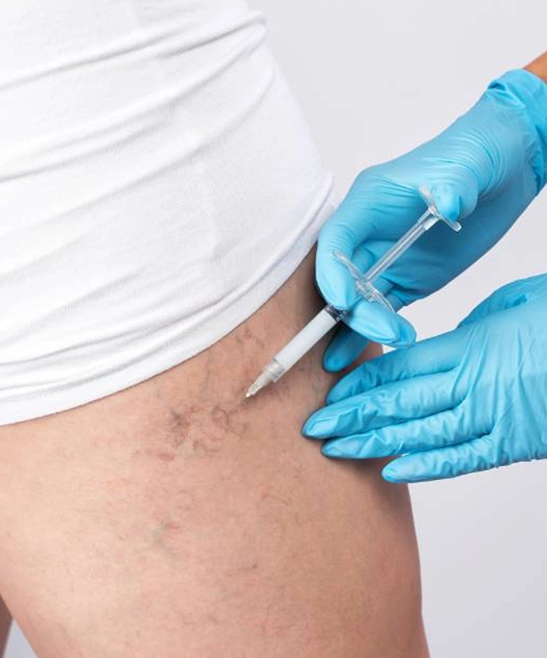 Cómo es el tratamiento de escleroterapia con microespuma