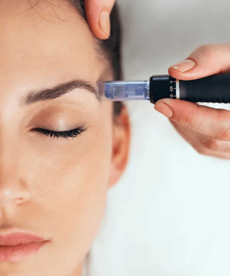 Cómo funciona el tratamiento de dermapen