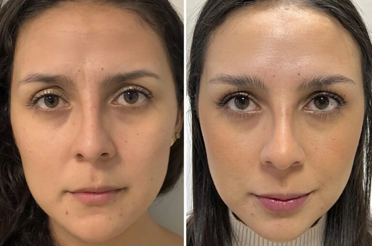 El antes y después del tratamientos antiarrugas Marbella