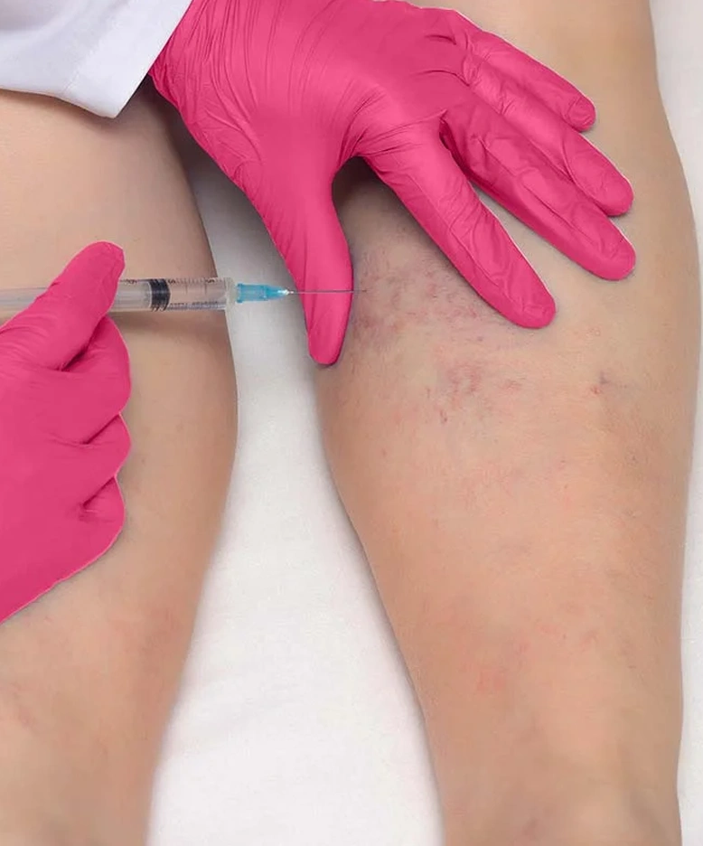 Qué son las varices Qué tipo de varices hay