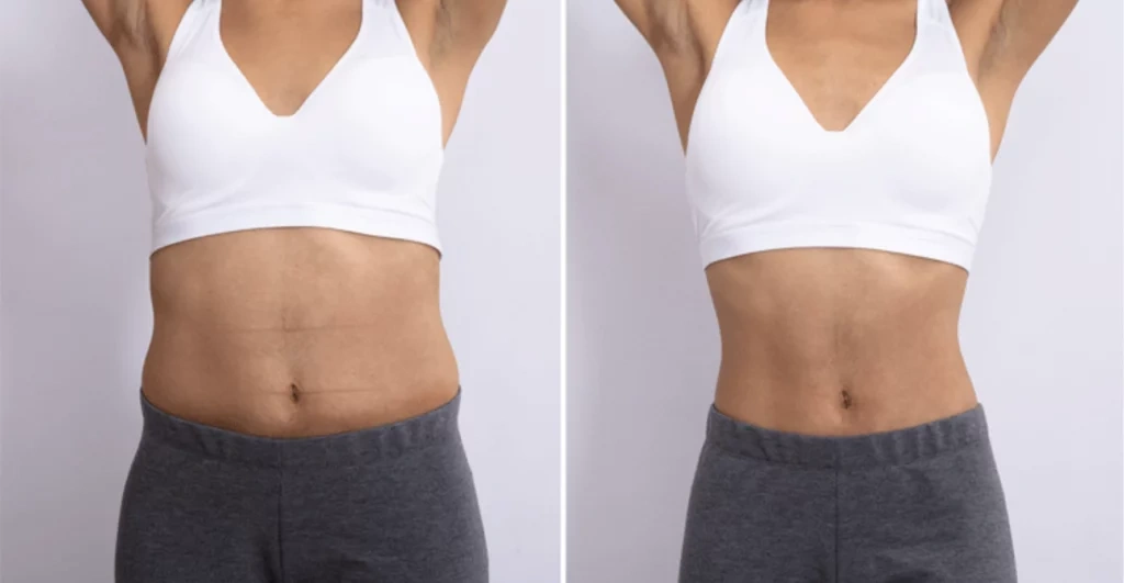 Resultados Adiós celulitis, grasa, flacidez