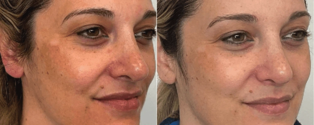 Resultados Antes y después del tratamientos facial