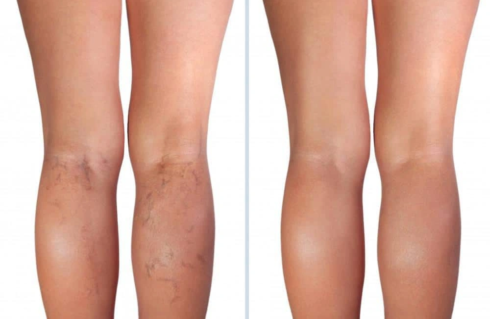 Resultados Elimina las varices en Marbella