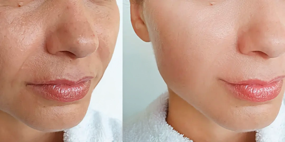 Resultados Rejuvenecimiento Facial