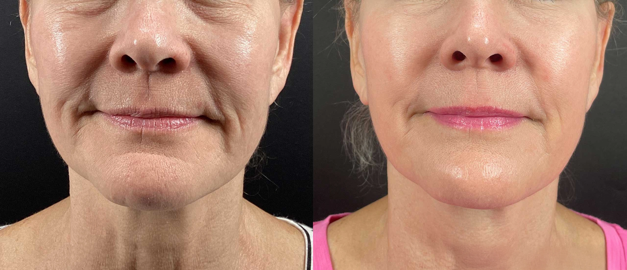 Resultados Rejuvenecimiento facial con tecnología avanzada