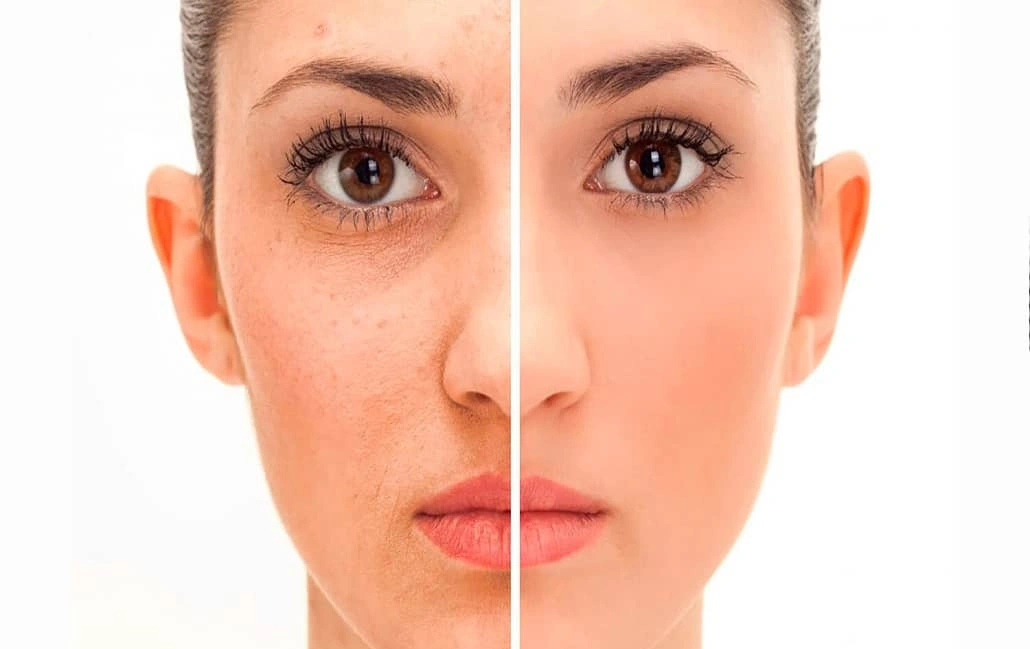 Resultados Rejuvenecimiento facial duradero