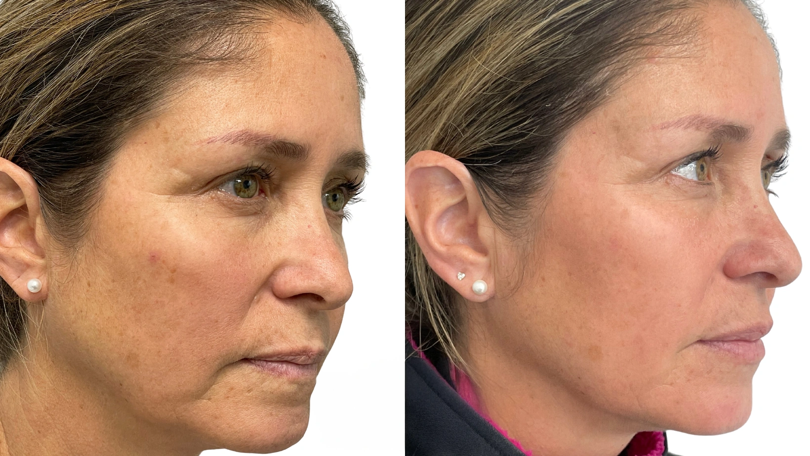 Resultados Relleno facial para rejuvenecer tu piel