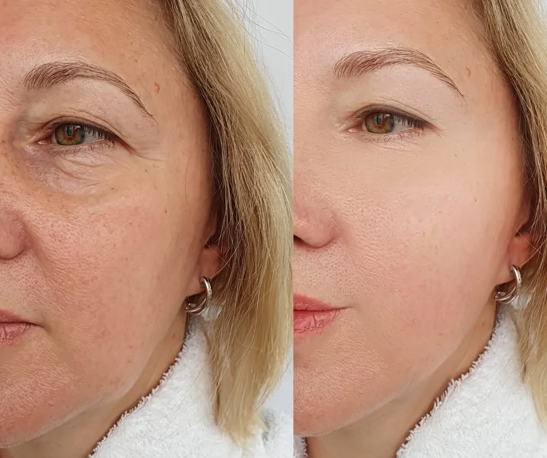 Resultados Solución de rejuvenecimiento facial