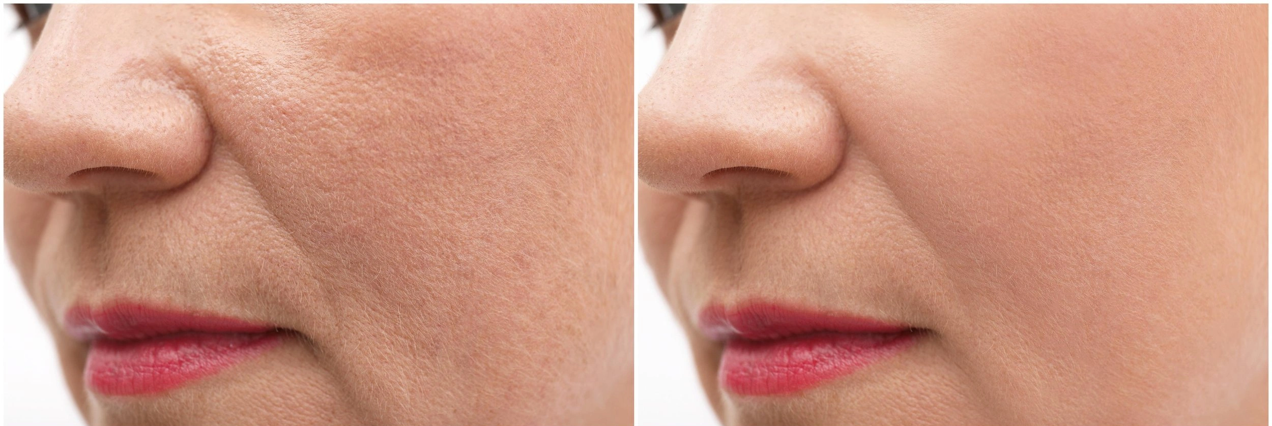 Resultados del HIFU Lifting facial sin cirugía