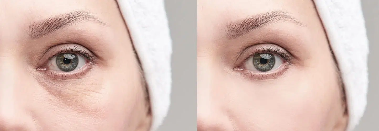 Resultados duraderos sin cirugía ojeras