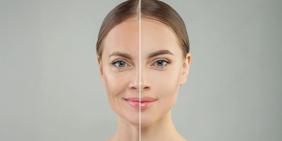 Tratamiento Faciales - antes despues